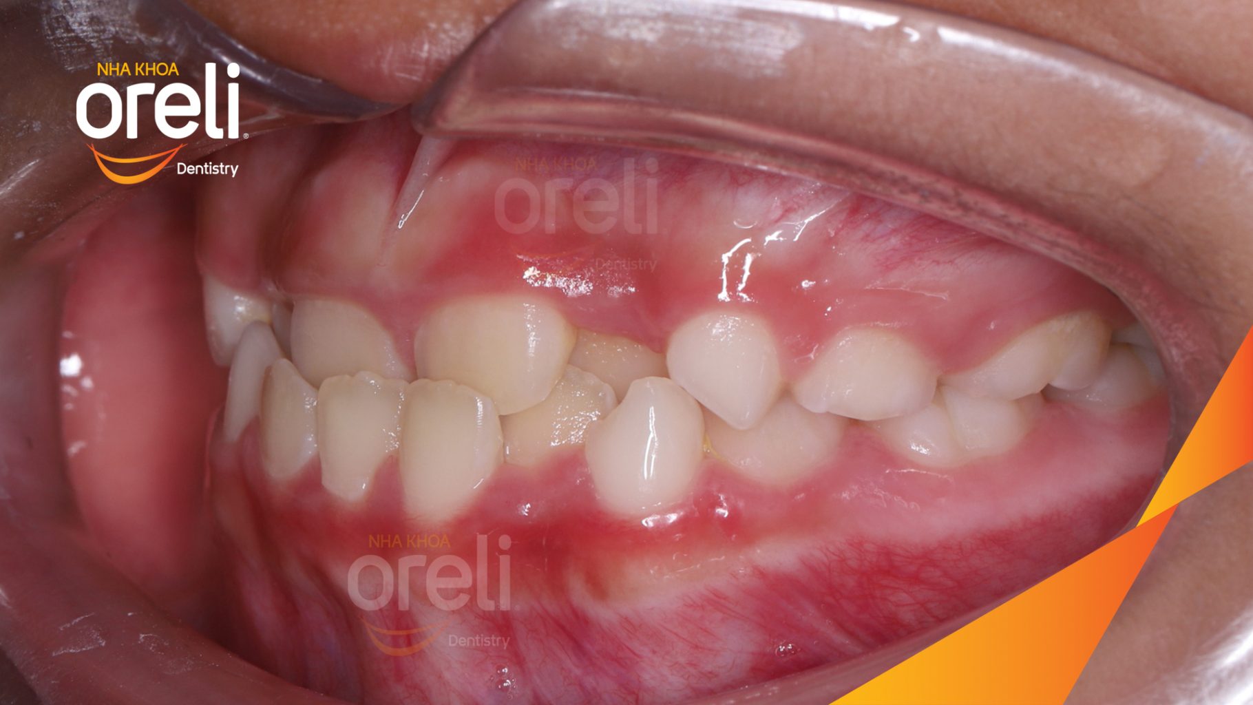 Trước điều trị: Cắn ngược răng cửa tại Nha khoa Oreli
