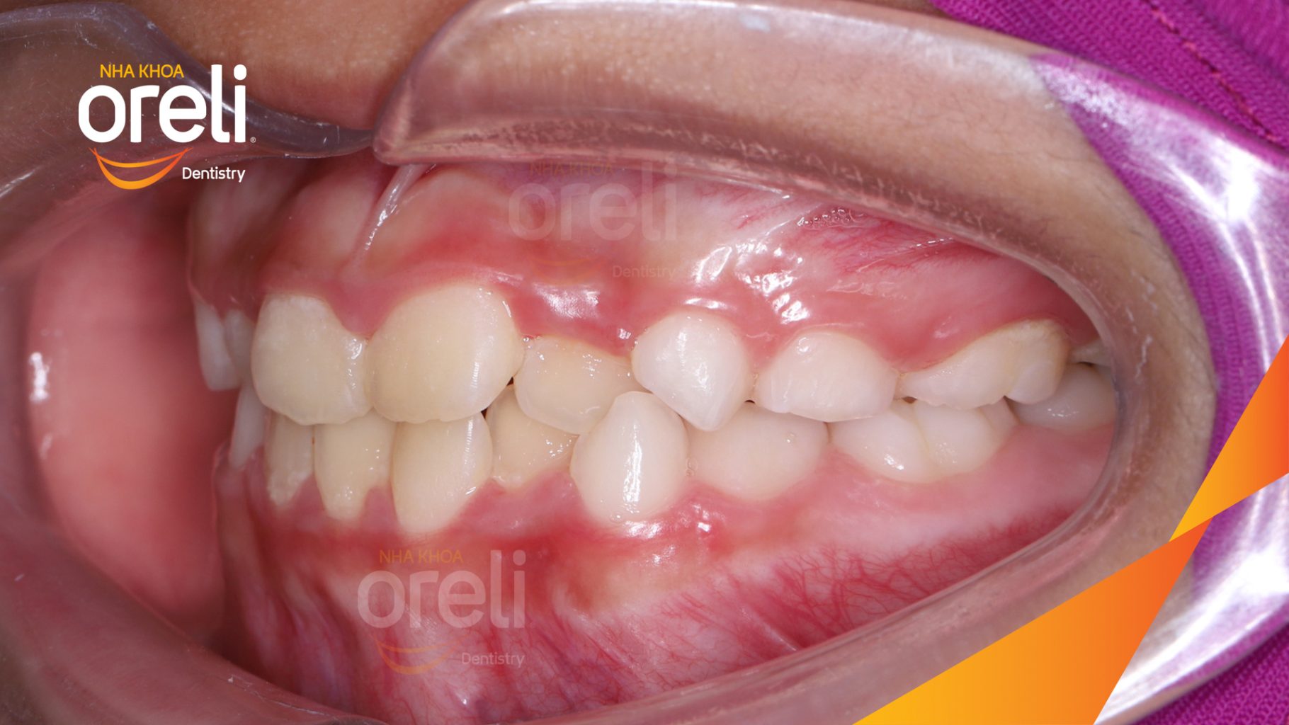 Cắn ngược răng cửa trước khi điều trị tại Nha khoa Oreli