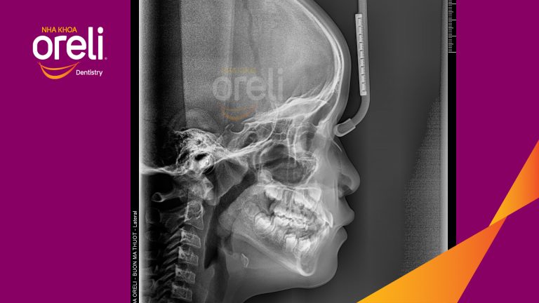 Chỉnh nha sớm ở trẻ em dưới 10 tuổi điều trị móm thành công ở Oreli