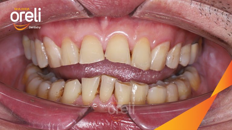 Dán sứ Veneer tại Nha khoa Oreli