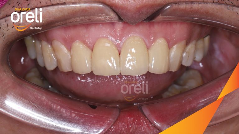 Dán sứ Veneer tại Nha khoa Oreli