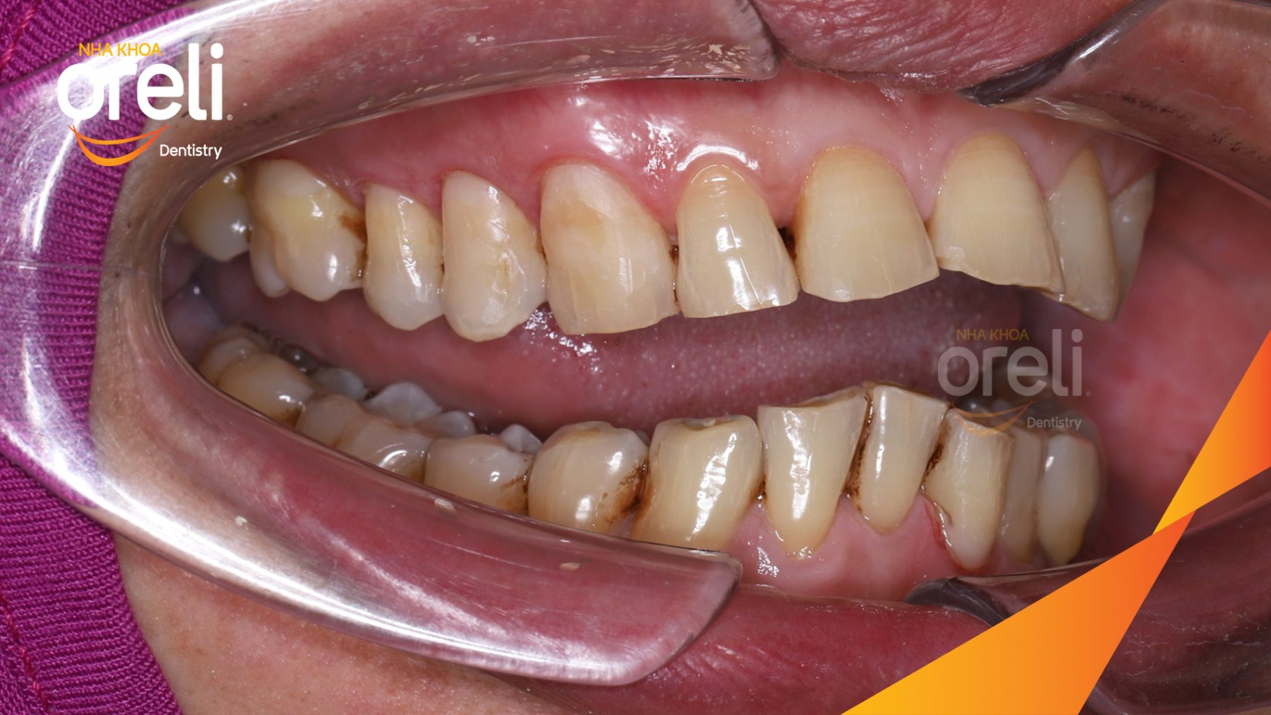 Kết quả sau : Màu răng  tự nhiên, nụ cười hài hòa, trẻ trung và tự tin hơn. tại Oreli