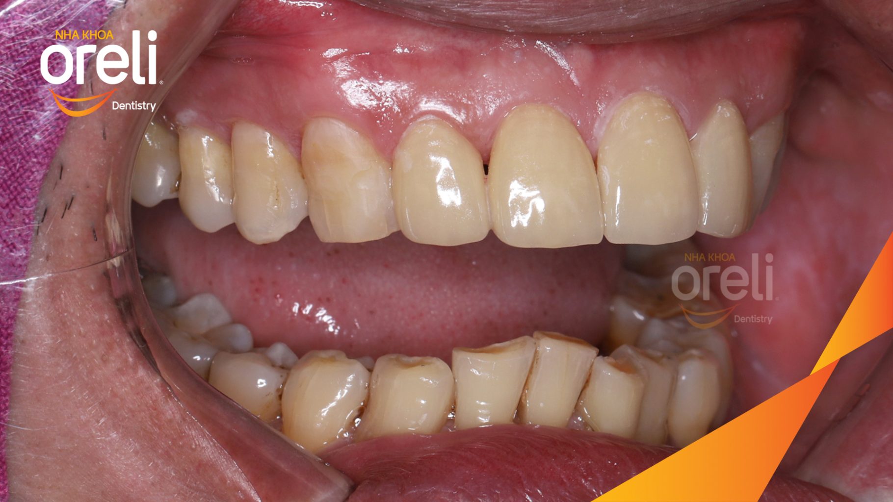 Kết quả đạt được sau  - Màu răng  tự nhiên, nụ cười hài hòa, trẻ trung và tự tin hơn. tại Oreli