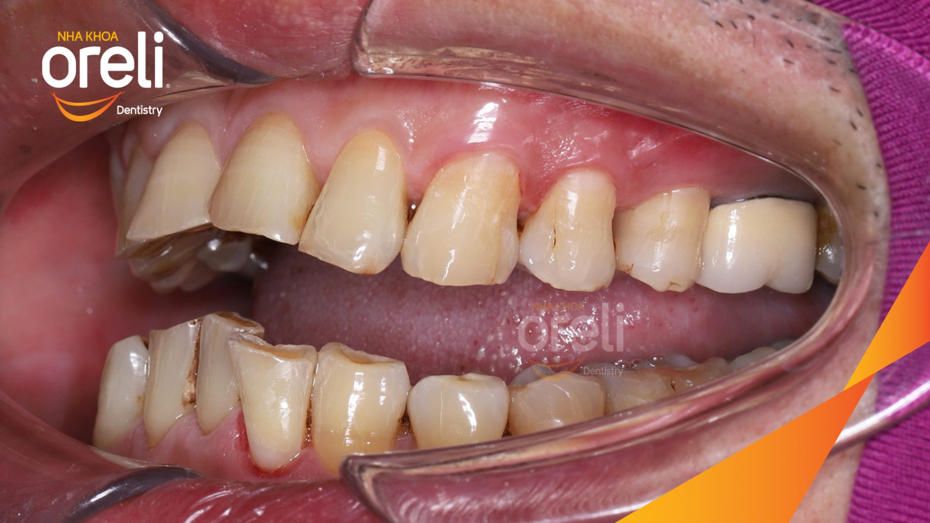 Trước điều trị: Răng xỉn màu, hình thể răng chưa cân đối tại Oreli