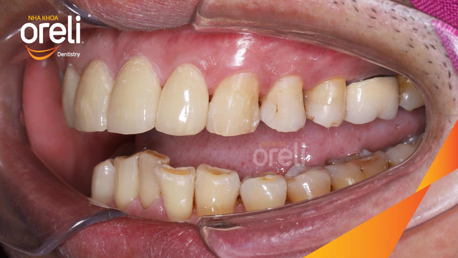 Răng xỉn màu, hình thể răng chưa cân đối trước khi điều trị tại Oreli