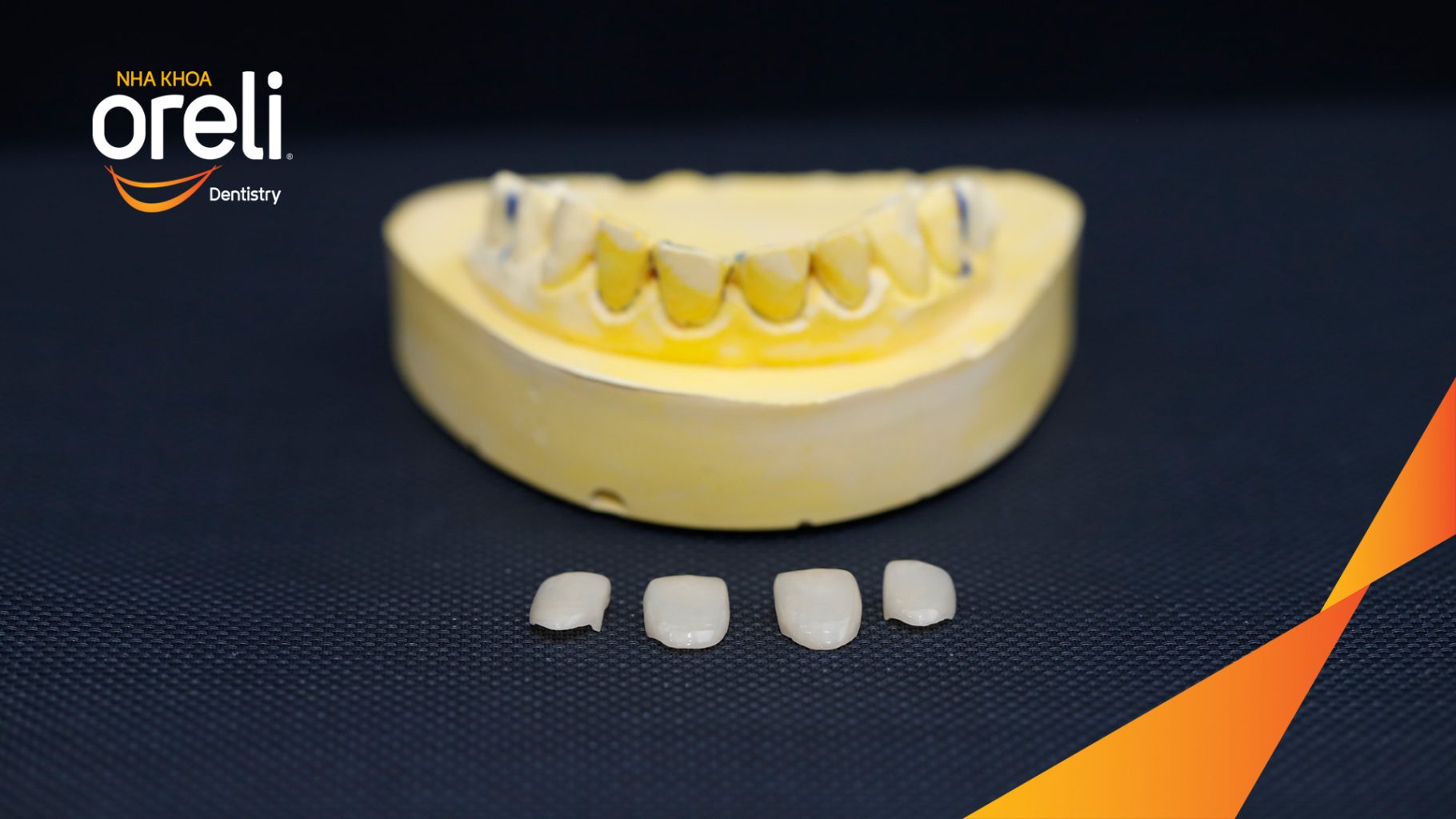 Trước điều trị: Răng xỉn màu, hình thể răng chưa cân đối tại Oreli