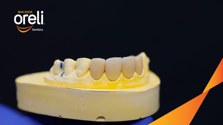 Dán sứ Veneer tại Nha khoa Oreli
