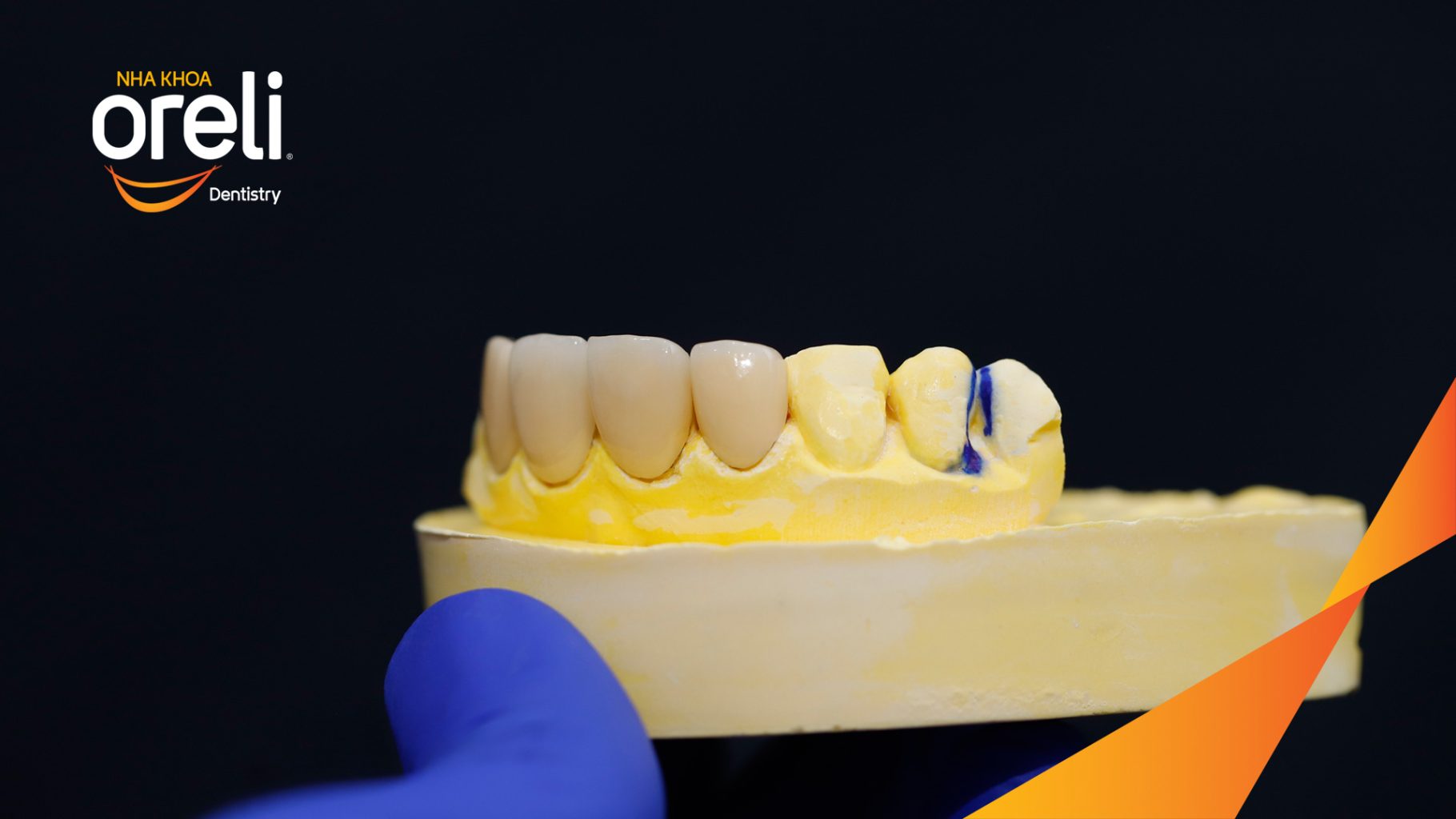 Thực hiện Thực hiện 4 mặt dán sứ Veneer vùng răng cửa kéo dài  tại Oreli