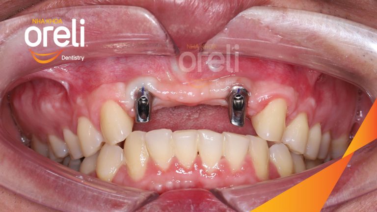 Ca Cấy Ghép Implant Hàm Trên – Case thực tế tại Oreli
