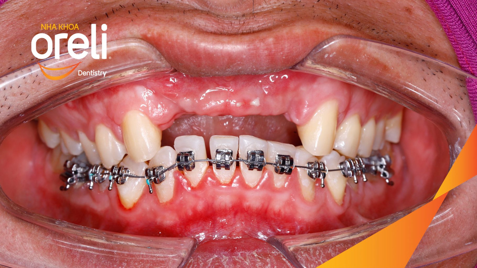 Quá trình Cấy ghép trụ Implant chính hãng vào vùng mất răng trong 3 tháng tại Oreli