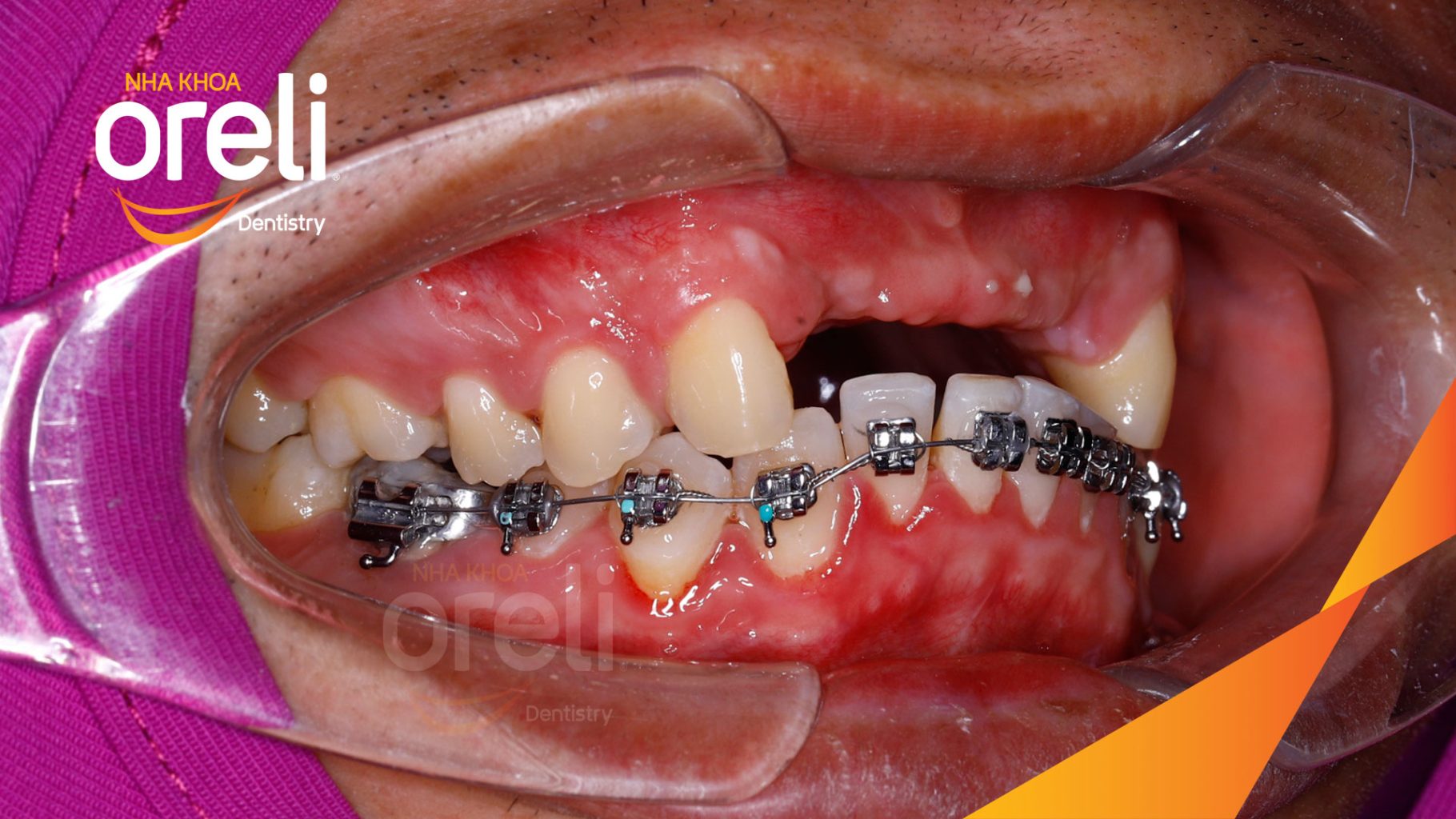 Thực hiện Cấy ghép trụ Implant chính hãng vào vùng mất răng kéo dài 3 tháng tại Oreli