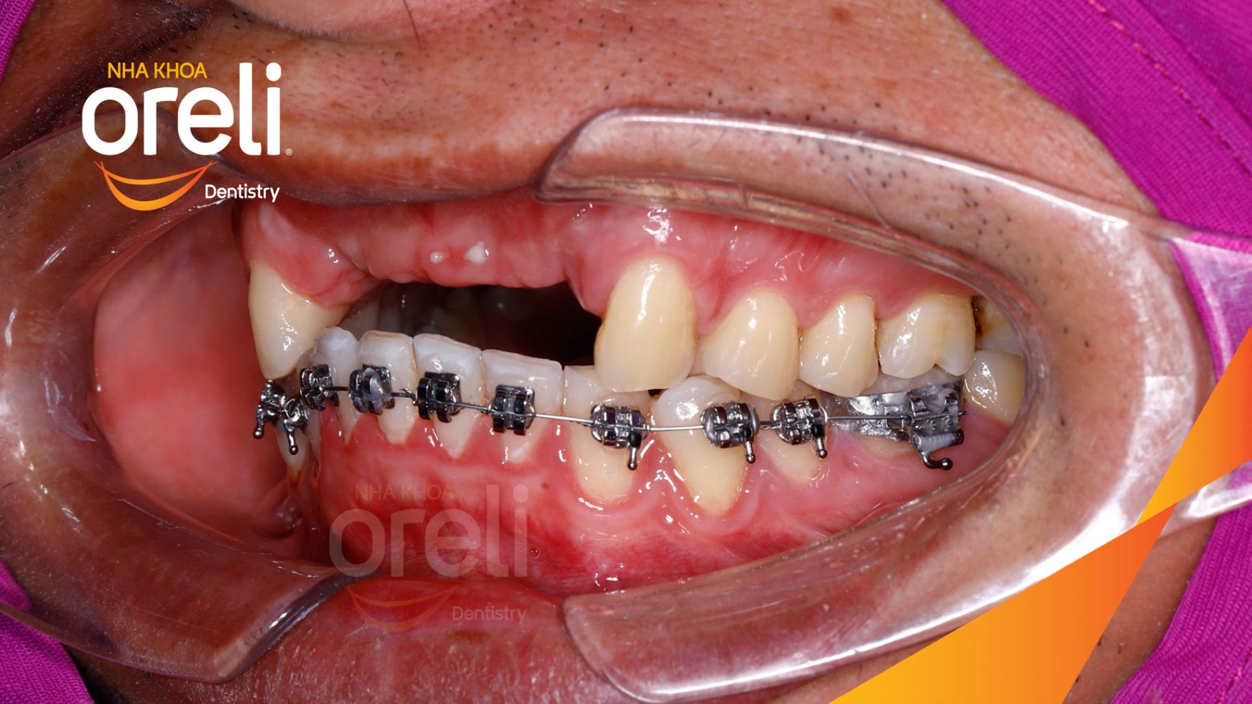 Kết quả đạt được sau 3 tháng - Phục hồi răng mất - ăn nhai chắc chắn và cười nói tự tin tại Oreli