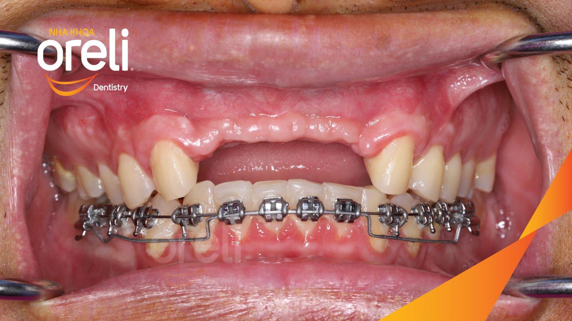 Kết quả sau 3 tháng: Phục hồi răng mất - ăn nhai chắc chắn và cười nói tự tin tại Oreli