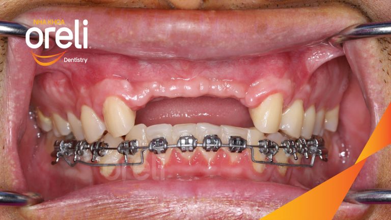 Ca Cấy Ghép Implant Hàm Trên – Case thực tế tại Oreli