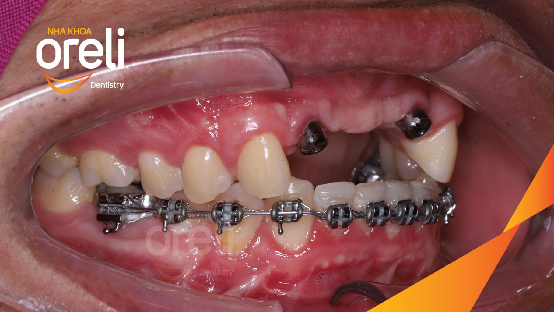Quá trình Cấy ghép trụ Implant chính hãng vào vùng mất răng trong 3 tháng tại Oreli