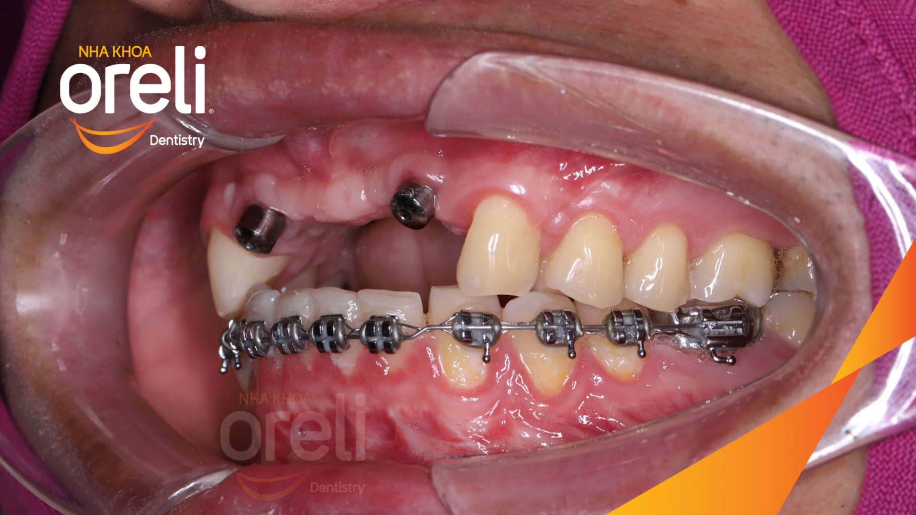 Thực hiện Cấy ghép trụ Implant chính hãng vào vùng mất răng kéo dài 3 tháng tại Oreli