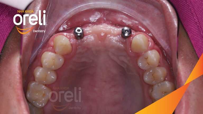 Ca Cấy Ghép Implant Hàm Trên – Case thực tế tại Oreli