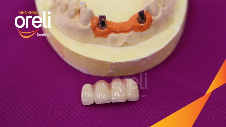 Ca Cấy Ghép Implant Hàm Trên – Case thực tế tại Oreli