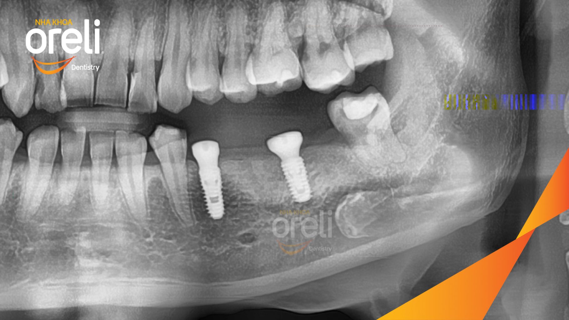 Mất răng hàm dưới trước khi điều trị tại Oreli