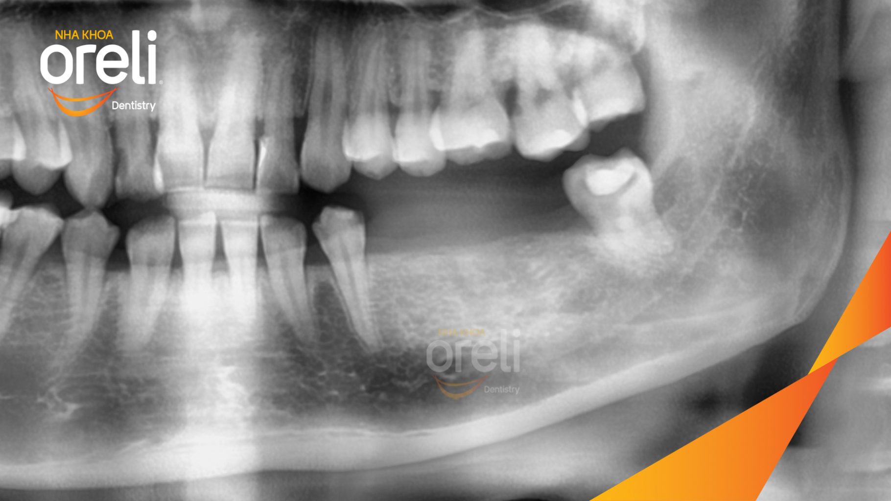 Trước điều trị: Mất răng hàm dưới tại Oreli