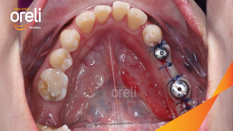 Ca Cấy Ghép Implant Phục Hồi Răng Mất Tại Nha Khoa Oreli