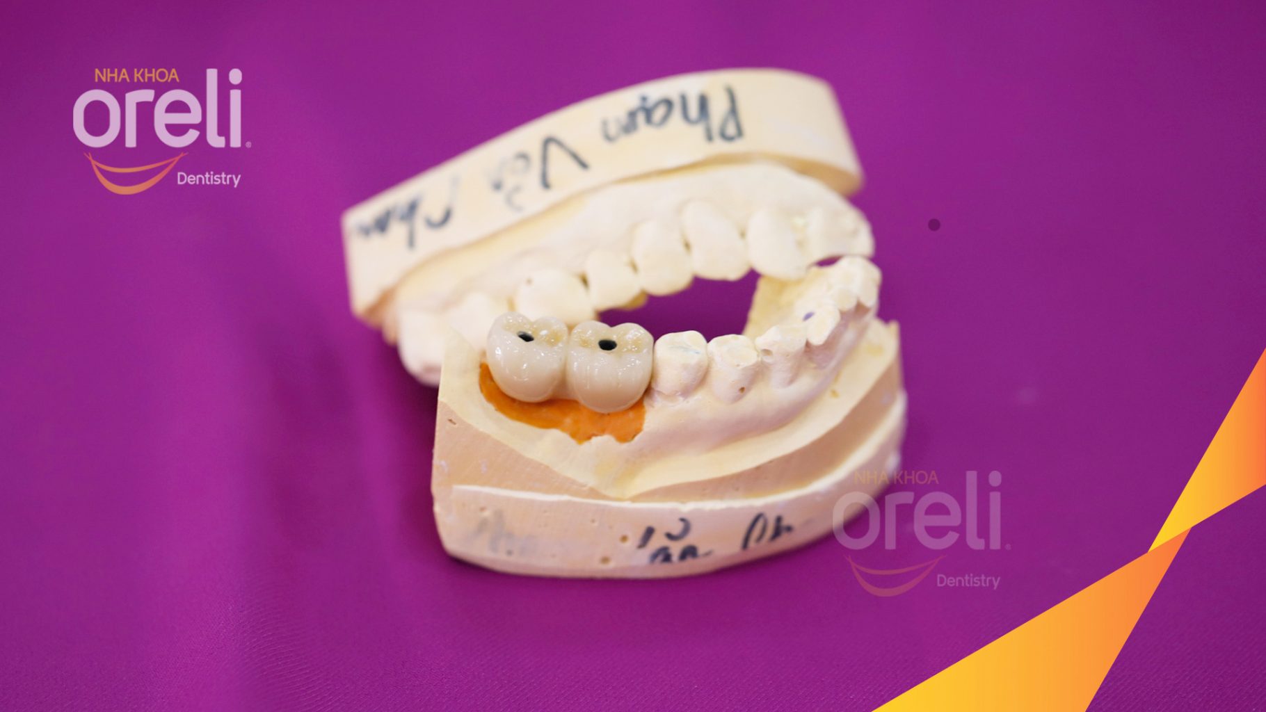 Kết quả đạt được sau 3 tháng - Phục hồi răng mất - ăn nhai chắc chắn và cười nói tự tin tại Oreli