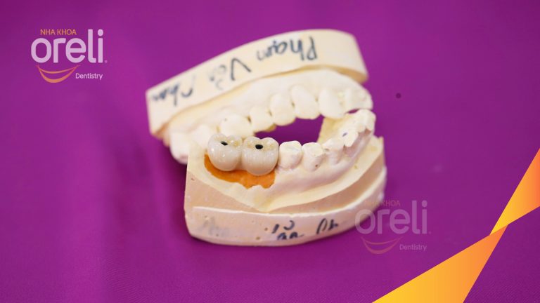 Ca Cấy Ghép Implant Hàm Dưới – Case thực tế tại Oreli