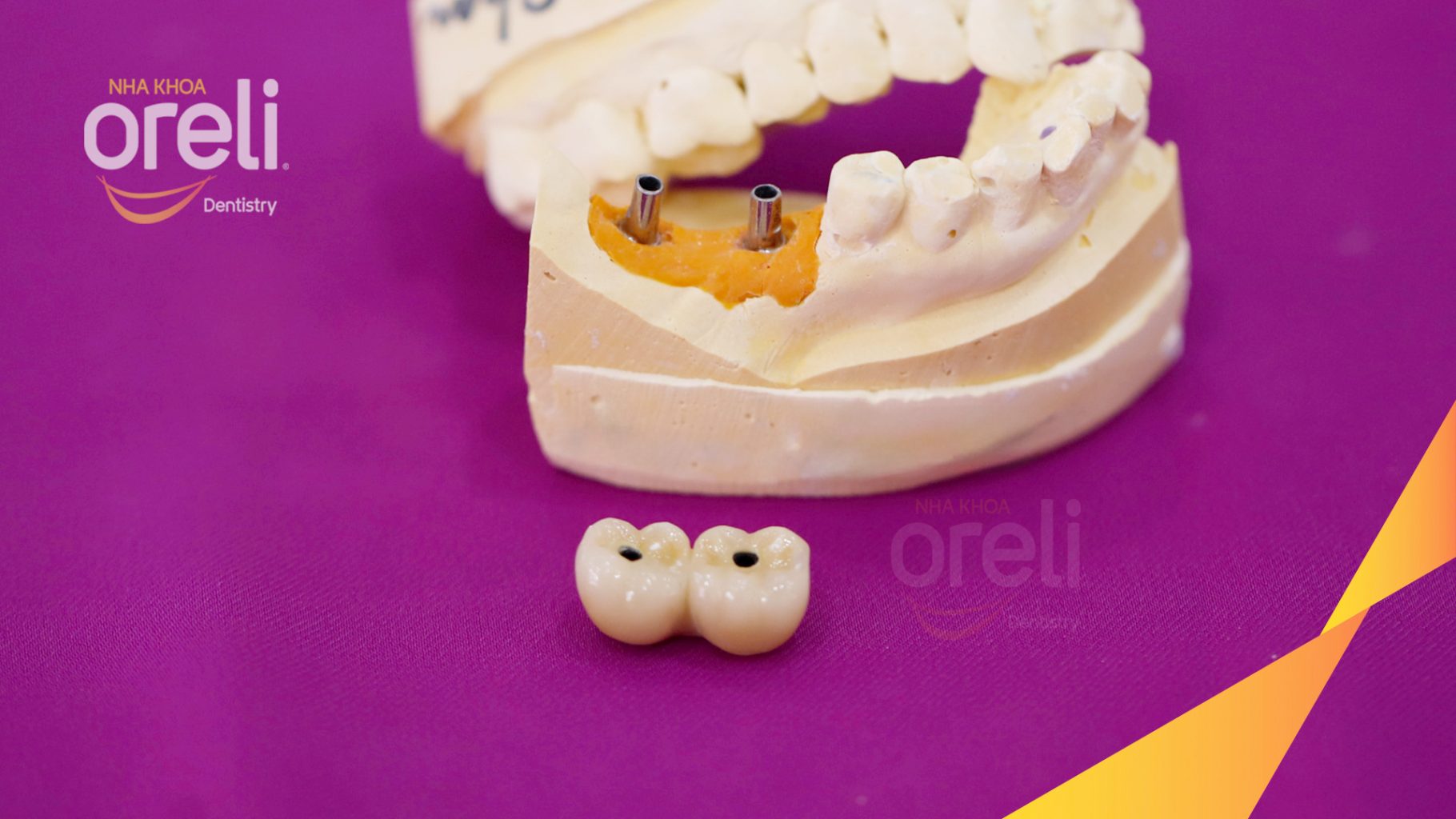 Kết quả sau 3 tháng: Phục hồi răng mất - ăn nhai chắc chắn và cười nói tự tin tại Oreli
