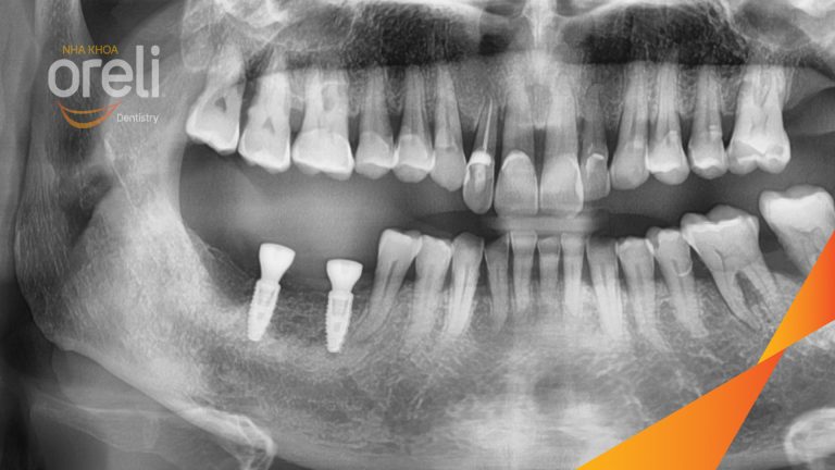 Ca Cấy Ghép Implant Hàm Dưới – Case thực tế tại Oreli