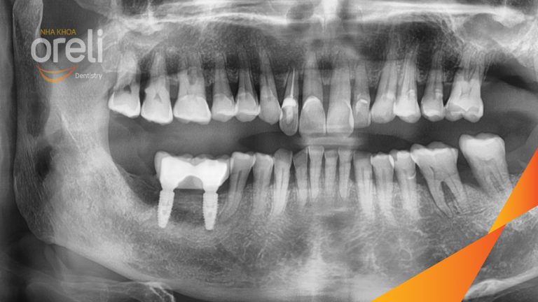 Ca Cấy Ghép Implant Hàm Dưới – Case thực tế tại Oreli
