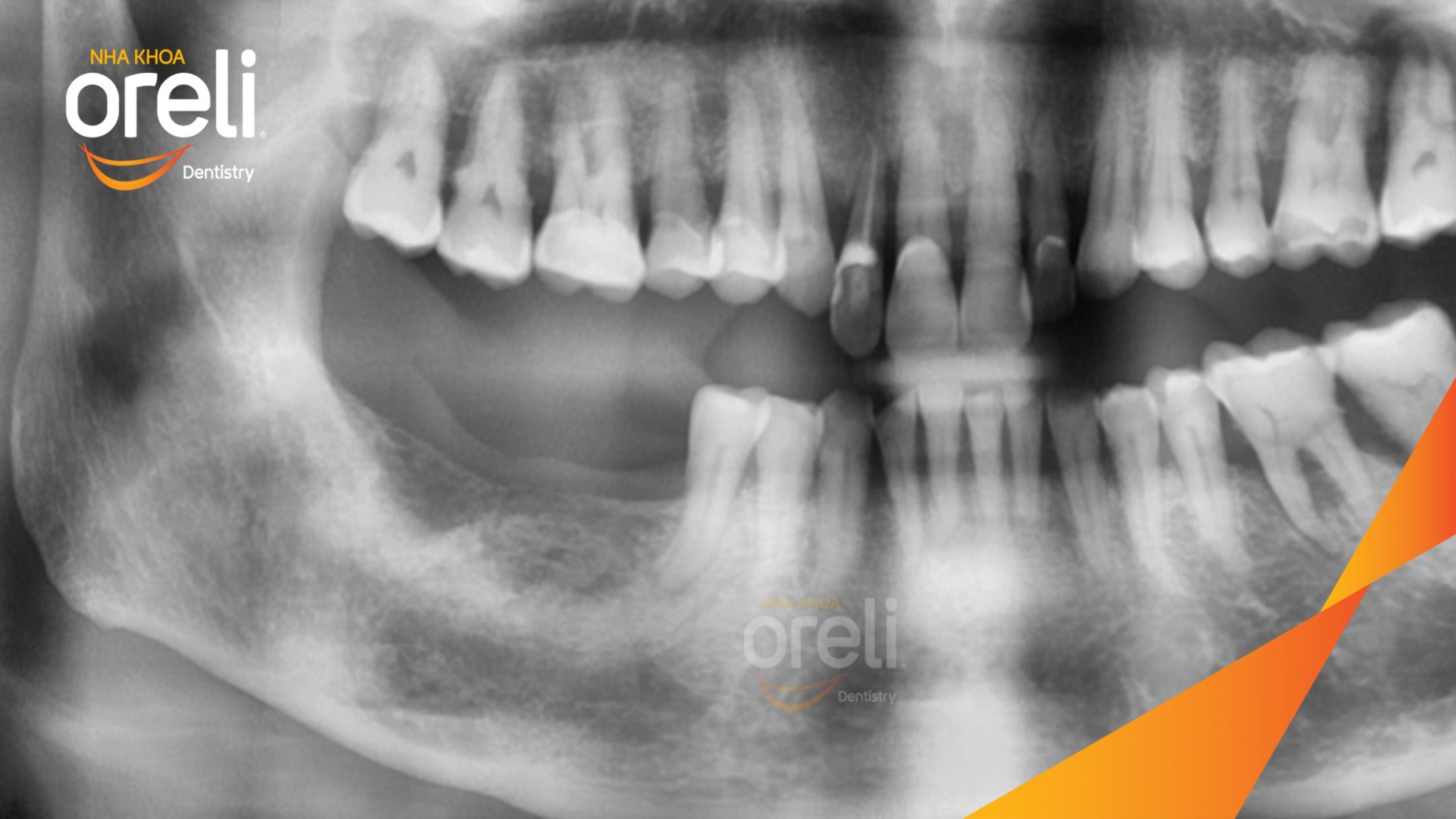 Trước điều trị: Mất răng hàm dưới tại Oreli