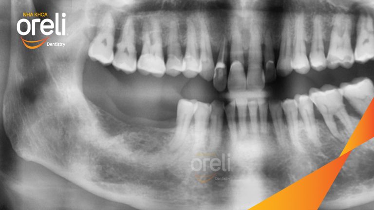 Ca Cấy Ghép Implant Hàm Dưới – Case thực tế tại Oreli