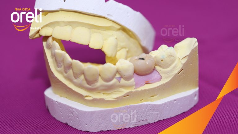 Ca Cấy Ghép Implant Hàm Dưới – Case thực tế tại Oreli