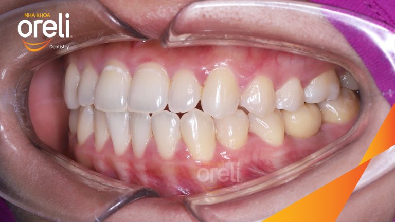 Ca Cấy Ghép Implant Hàm Dưới – Case thực tế tại Oreli