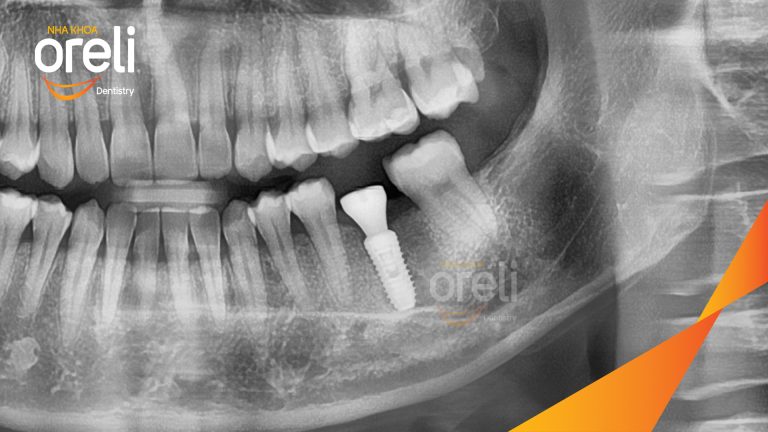 Ca Cấy Ghép Implant Hàm Dưới – Case thực tế tại Oreli