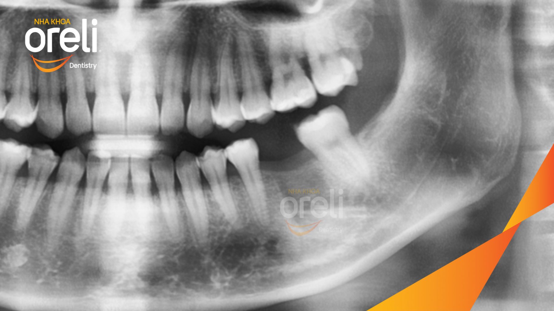 Trước điều trị: Khách hàng mất răng hàm dưới thời gian dài, gây ảnh hưởng đến khả năng ăn nhai  tại Oreli