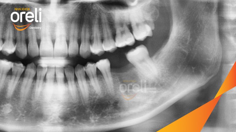Ca Cấy Ghép Implant Hàm Dưới – Case thực tế tại Oreli