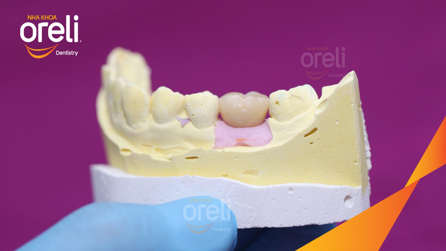 Kết quả đạt được sau 3 tháng -  Phục hồi răng mất - ăn nhai chắc chắn và cười nói tự tin tại Oreli