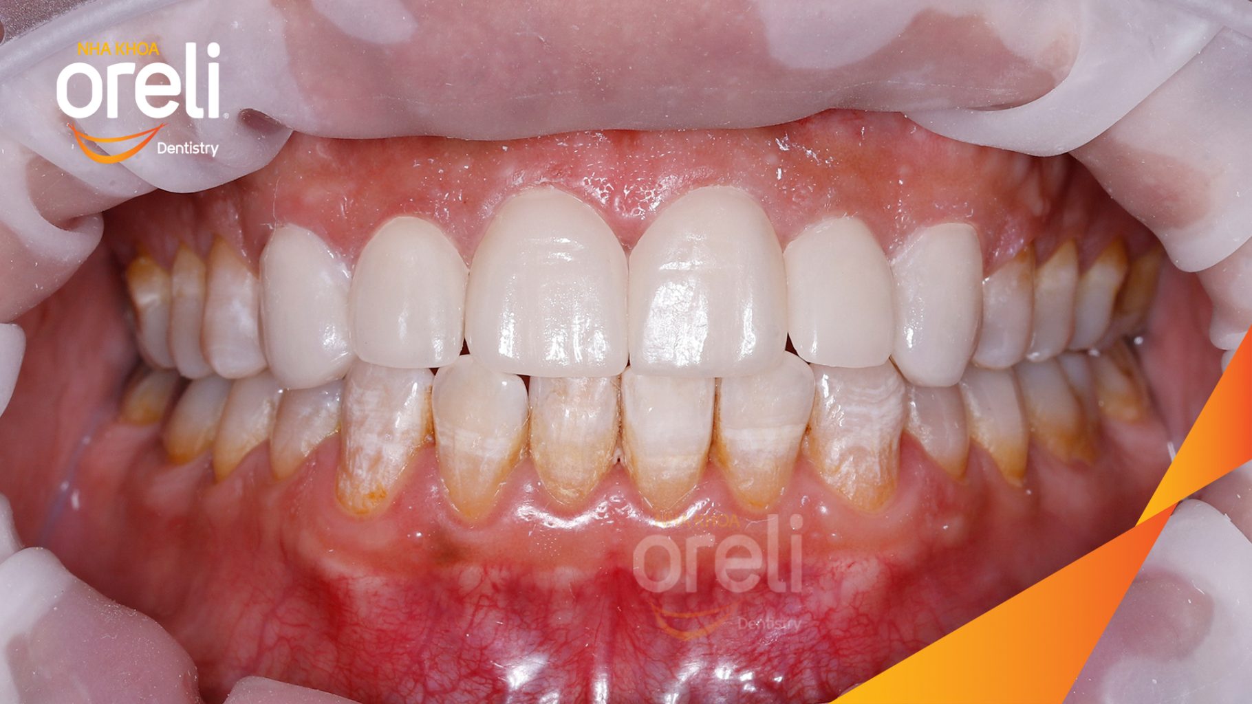 Kết quả sau : Màu răng trắng sáng tự nhiên, nụ cười hài hòa, trẻ trung và tự tin hơn. tại Oreli