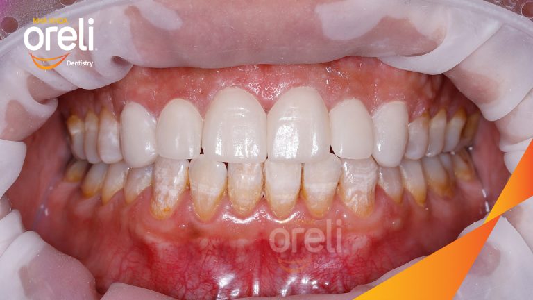 Dán sứ Veneer tại Nha khoa Oreli