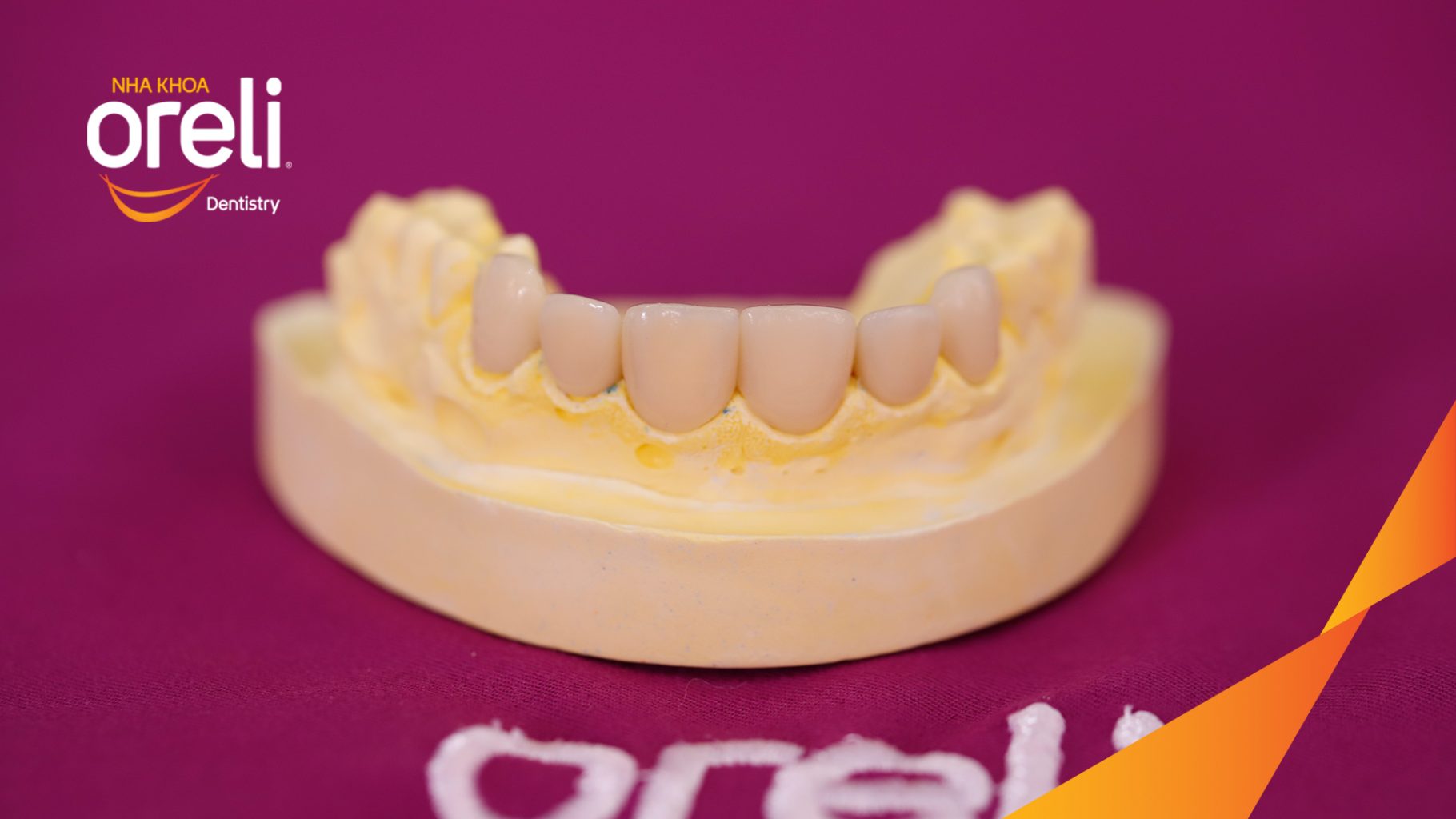 Răng xỉn màu, hình thể răng chưa cân đối trước khi điều trị tại Oreli