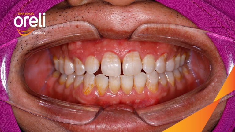 Dán sứ Veneer tại Nha khoa Oreli