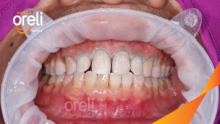 Dán sứ Veneer tại Nha khoa Oreli