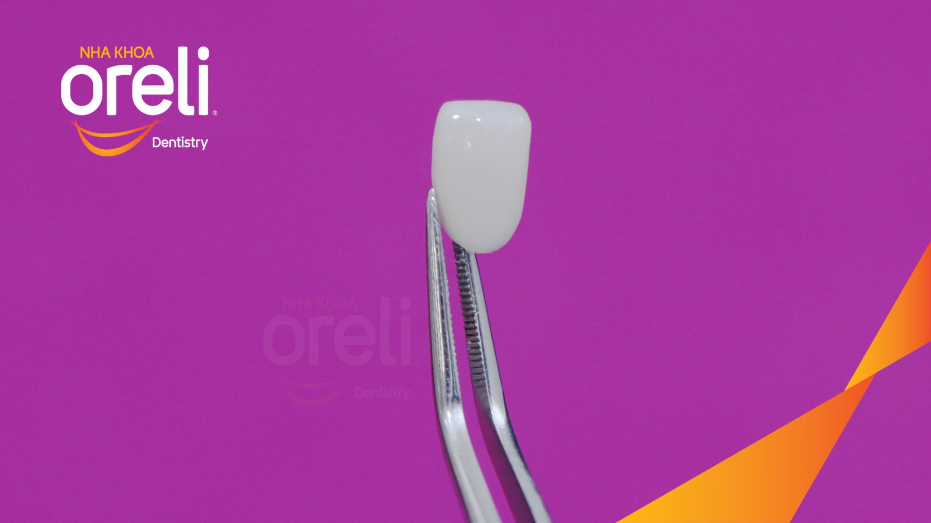 Quá trình Dán sứ Veneer thẩm mỹ với thiết kế dáng răng tự nhiên trong  tại Oreli