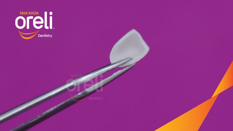 Dán sứ Veneer tại Nha khoa Oreli