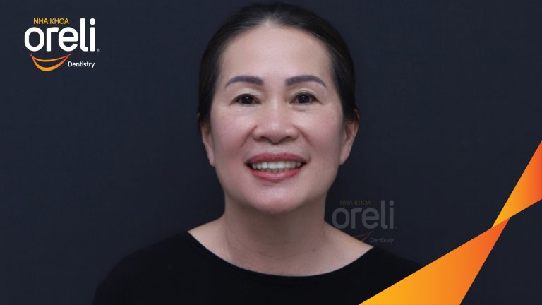 Dán sứ Veneer tại Nha khoa Oreli