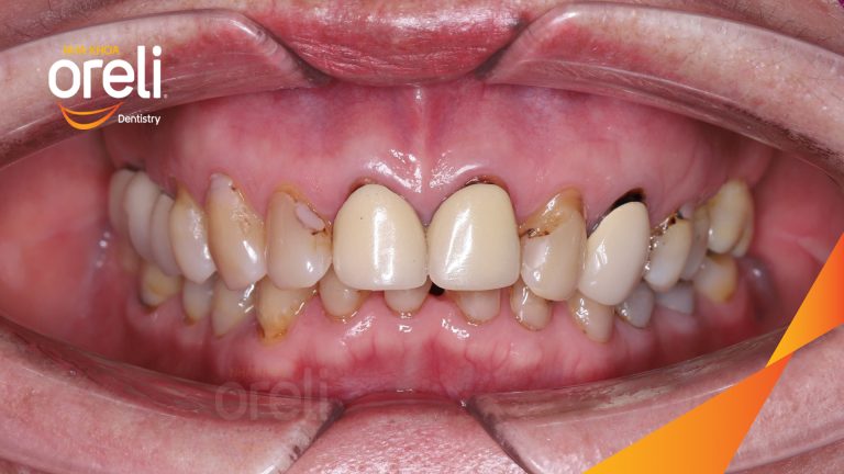 Dán sứ Veneer tại Nha khoa Oreli