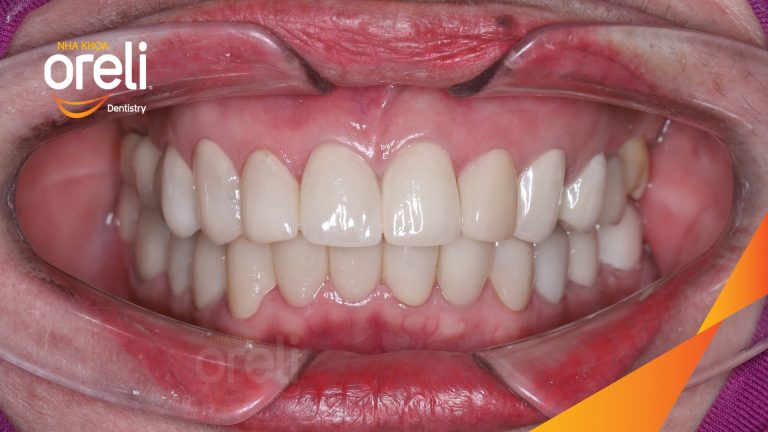 Dán sứ Veneer tại Nha khoa Oreli