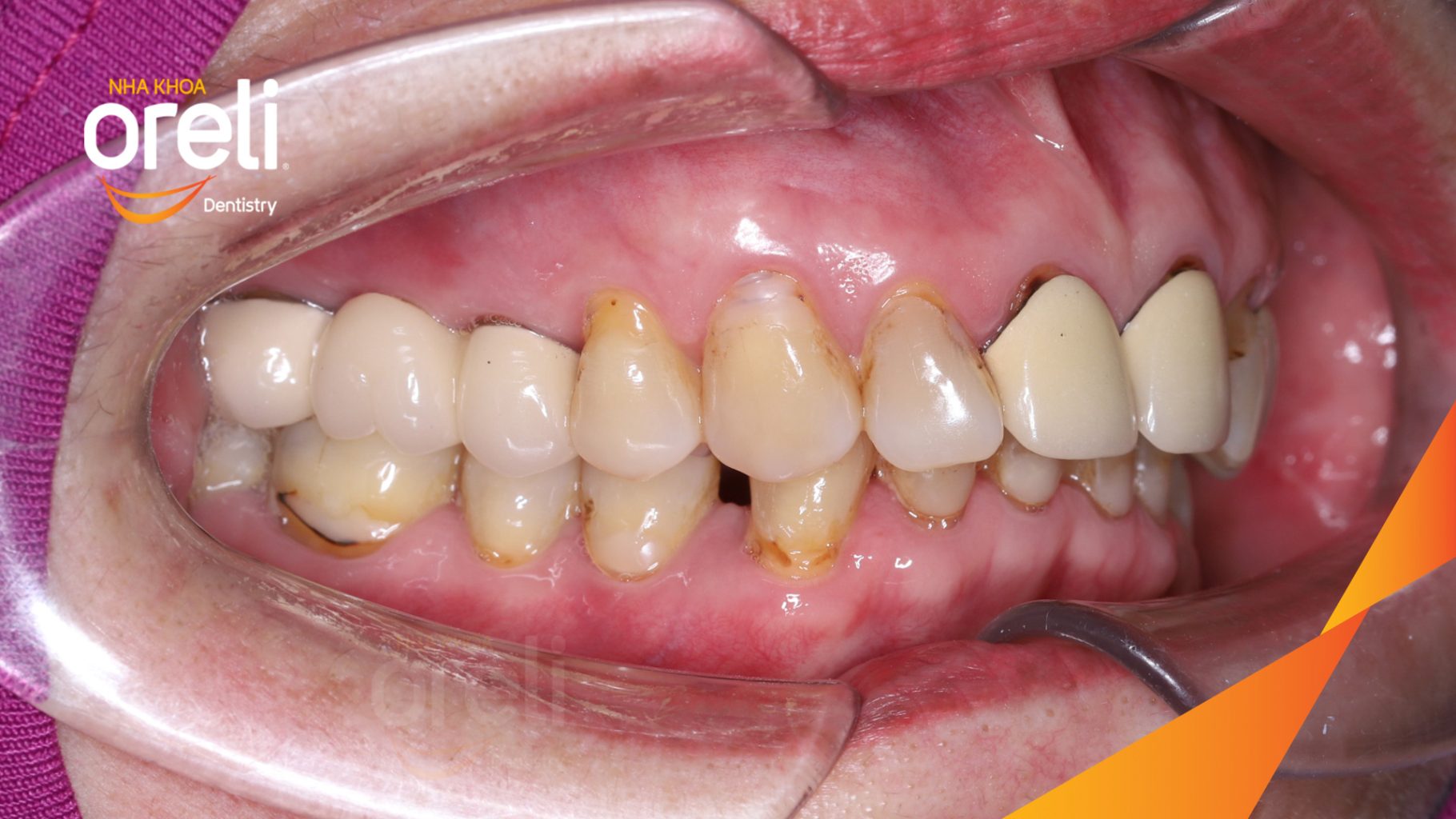 Trước điều trị: Răng xỉn màu, hình thể răng chưa cân đối tại Oreli
