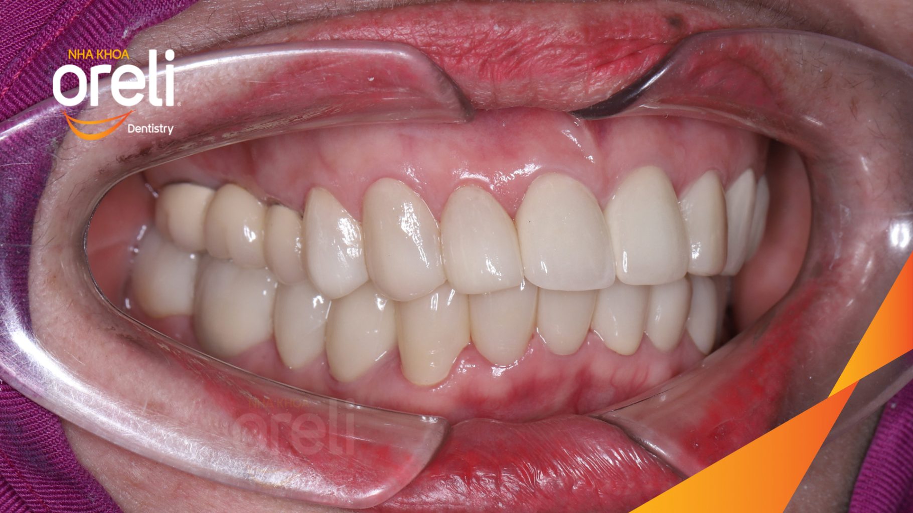 Răng xỉn màu, hình thể răng chưa cân đối trước khi điều trị tại Oreli